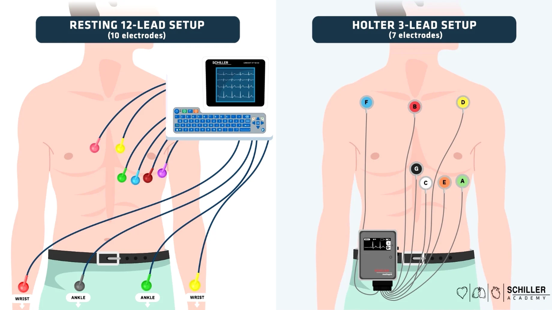 Video still: resting 12-lead and Holter 3-lead electrode setups